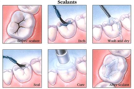 Sealants