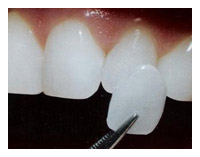 Veneers/Laminates